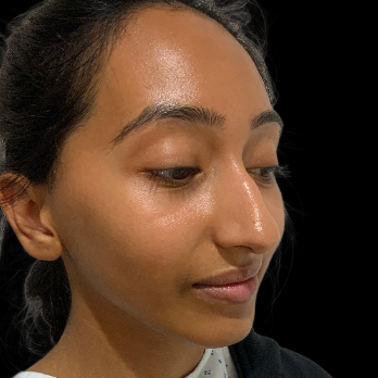 ethnic-rhinoplasty-before